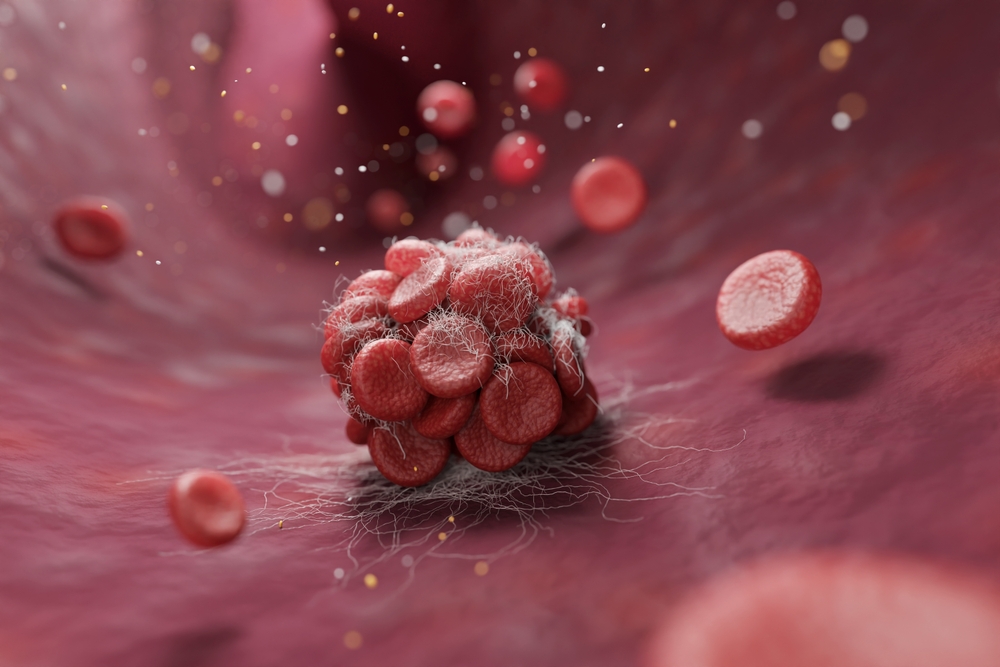 You are currently viewing $570K Awarded In Wrongful Death Lawsuit After Doctor Failed To Diagnose Fatal Blood Clot